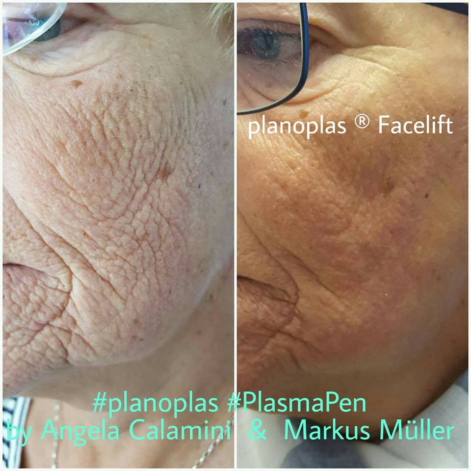 woman's cheek before and after PlasmaMD treatment