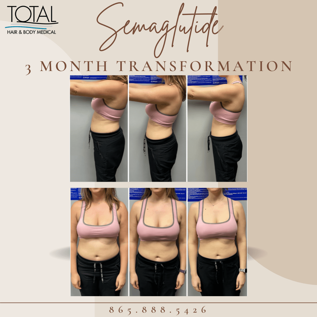 3 month weight loss transformation of a woman using Semaglutide at Total Hair & Body Medical in Knoxville TN